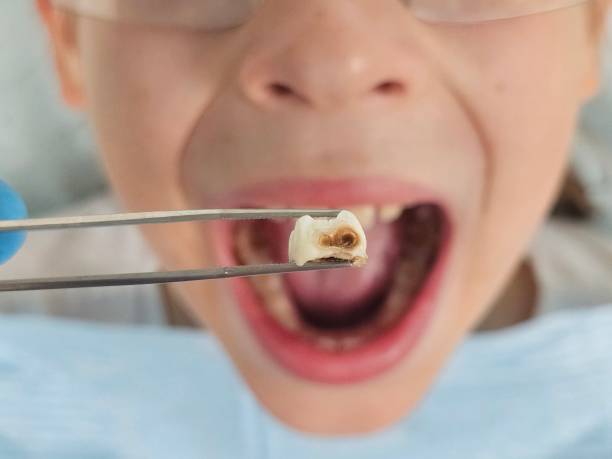 Best Emergency Dental Services for Seniors in Grayson, CA