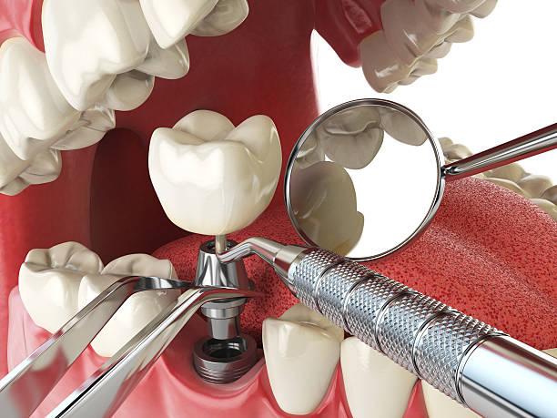 Best Emergency Dental Extractions in Grayson, CA