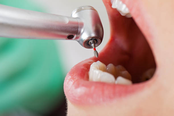 Best Emergency Dentist for Knocked-Out Tooth in Grayson, CA